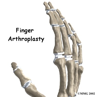 Artificial Joint Replacement of the Finger - FYZICAL Algonac's Guide