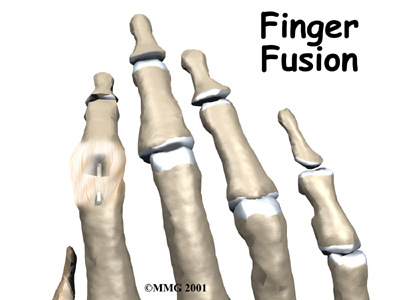 Finger Fusion Surgery - FYZICAL Briargate's Guide