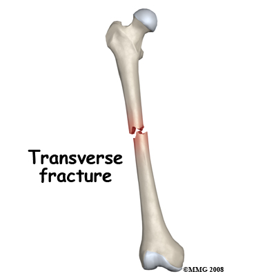 transverse fracture