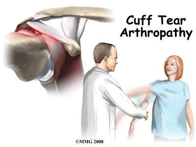 rotator cuff tear physical therapy