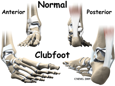 Physical Therapy In Plymouth For Pediatric Issues Clubfoot