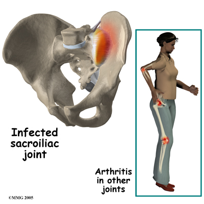 Physical Therapy in Memphis for - Joint Dysfunction