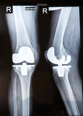 Key Muscles in Knee Replacement Rehabilitation
