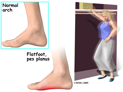 Adult Acquired Flatfoot Deformity